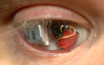 Man explains why he replaced his lost eye with a wireless camera