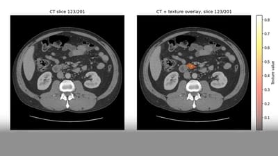 AI is able to spot pancreatic cancer years before a regular diagnosis would happen, study finds