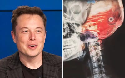 Elon Musk’s Neuralink is looking for a volunteer to have a chip implanted in their brain