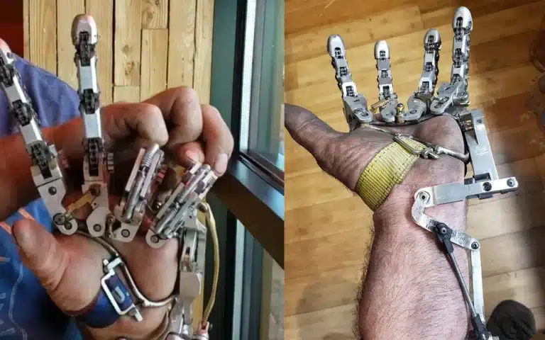 mechanical DIY prosthetic hand ian davis