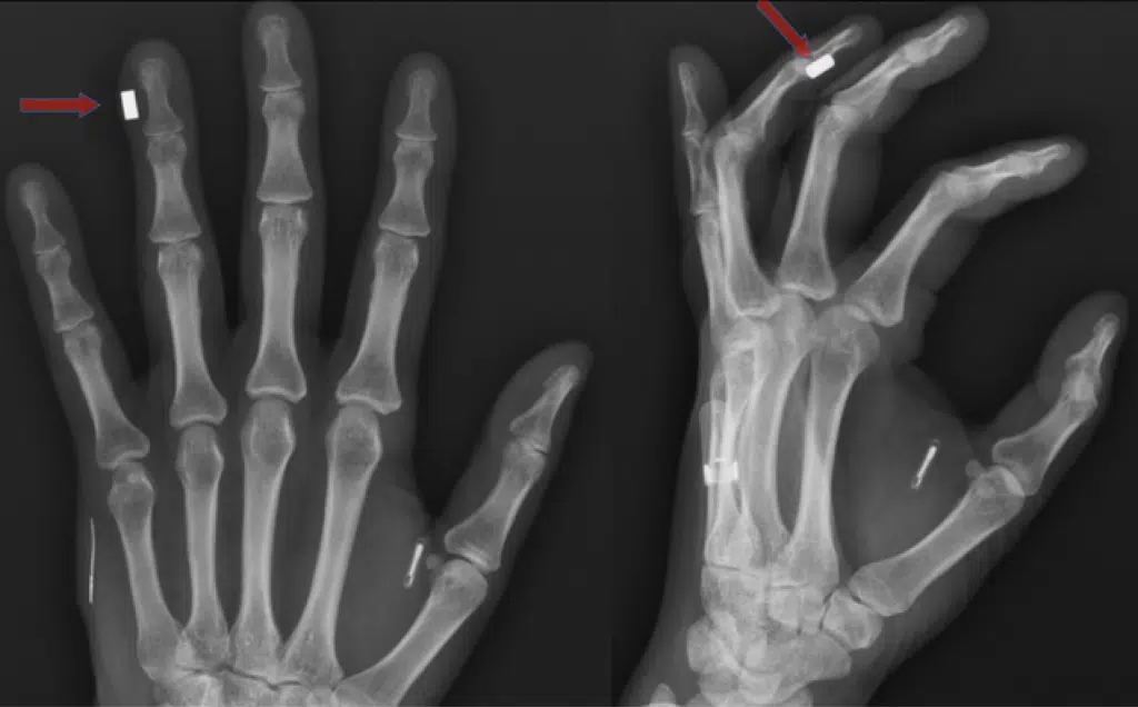 Microchip implants are increasing in popularity in Sweden